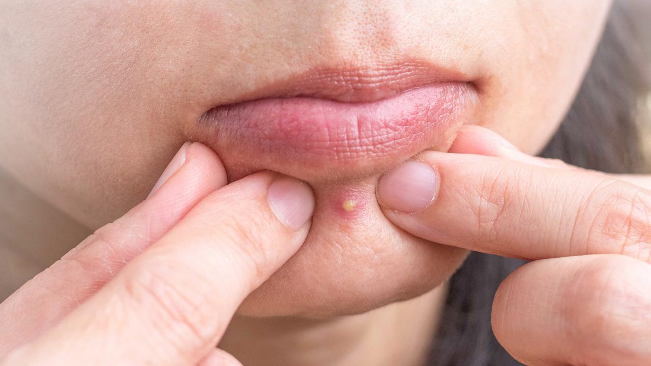 How to heal a popped pimple overnight