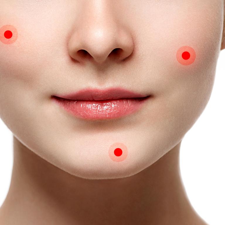 Put to pimples what redness reduce on to 12 Proven